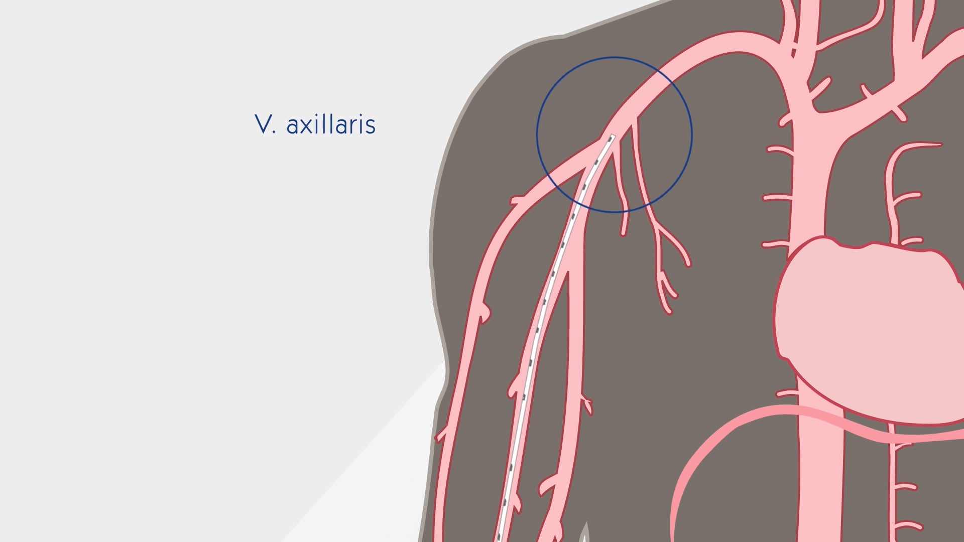 Informationen Midline-Katheter