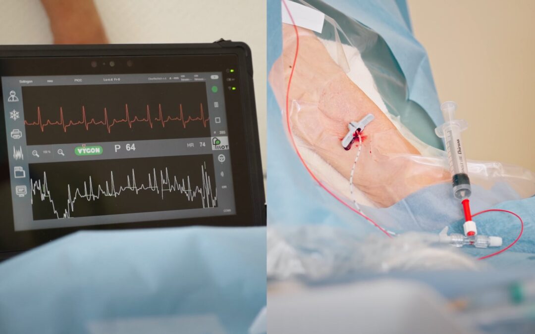 Intrakavitäres EKG-Verfahren zur Katheterspitzen-Positionierung bei ZVKs