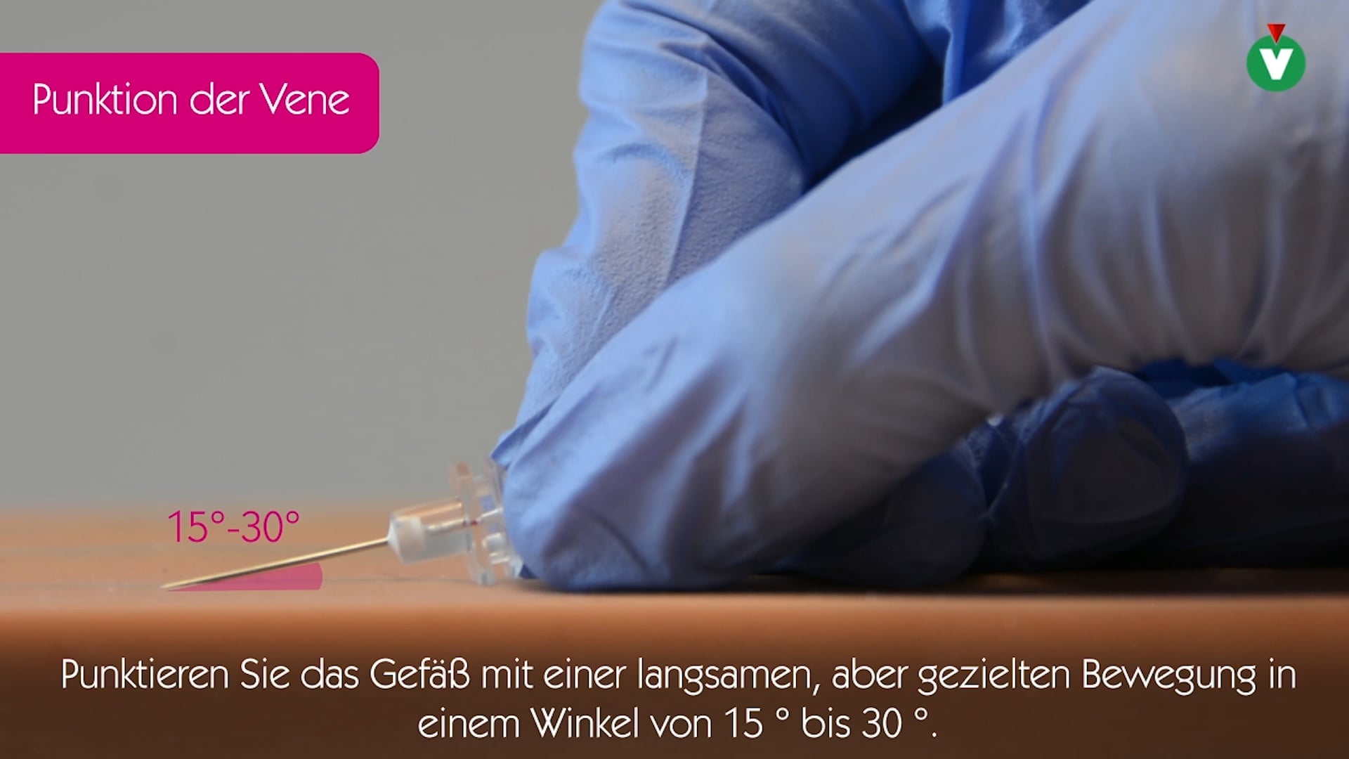 Tipps und Tricks bezüglich des Mikroseldinger-Einführbestecks