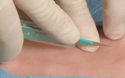 Thoraxdrainage – Anlage nach PLACE