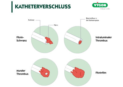 Katheterverschluss