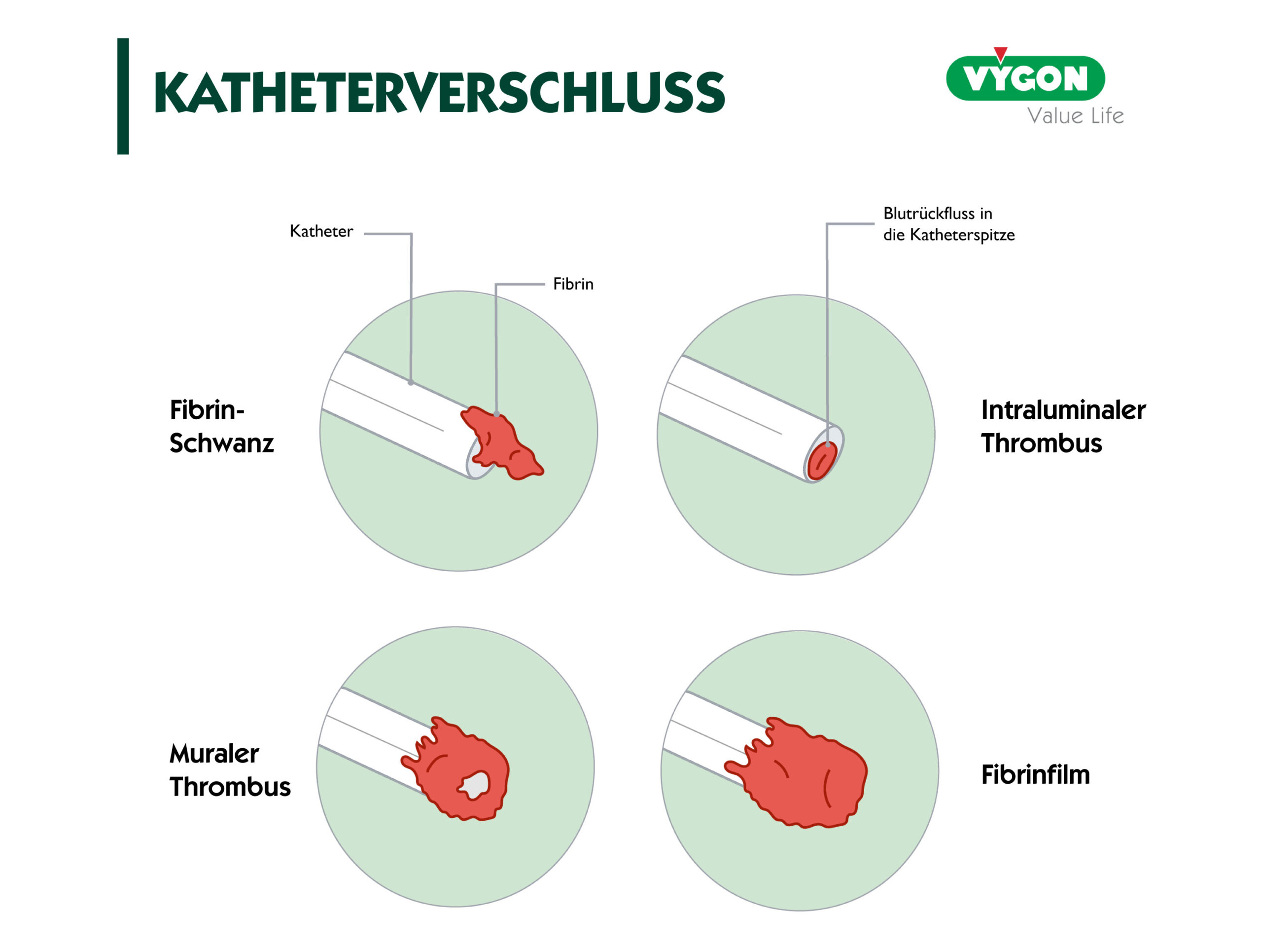 Katheterverschluss