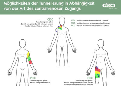 Möglichkeiten der Tunnelierung in Abhängigkeit von der Art des zentralvenösen Zugangs