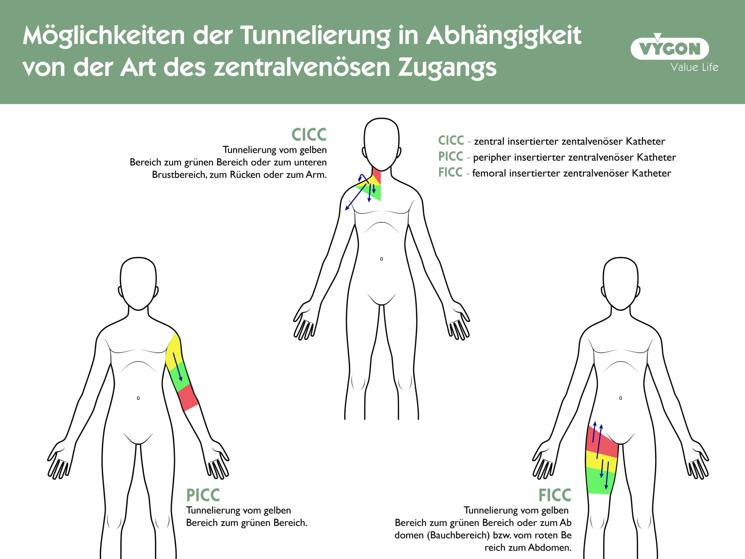 Möglichkeiten der Tunnelierung in Abhängigkeit von der Art des zentralvenösen Zugangs