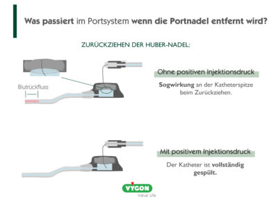 Was passiert im Portsystem, wenn die Portnadel entfernt wird?
