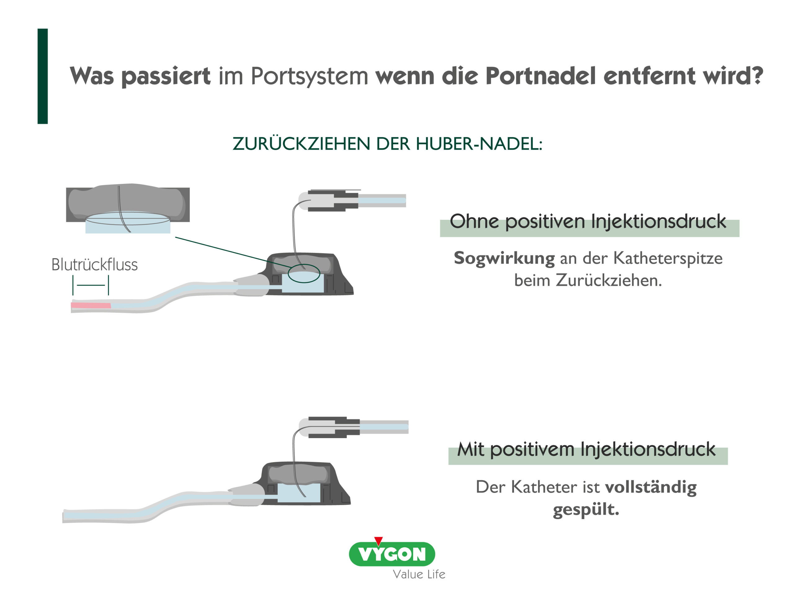 Was passiert im Portsystem, wenn die Portnadel entfernt wird