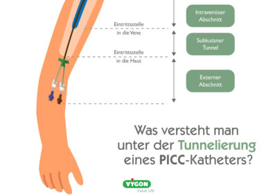 Was versteht man unter der Tunnelierung eines PICC-Katheters?