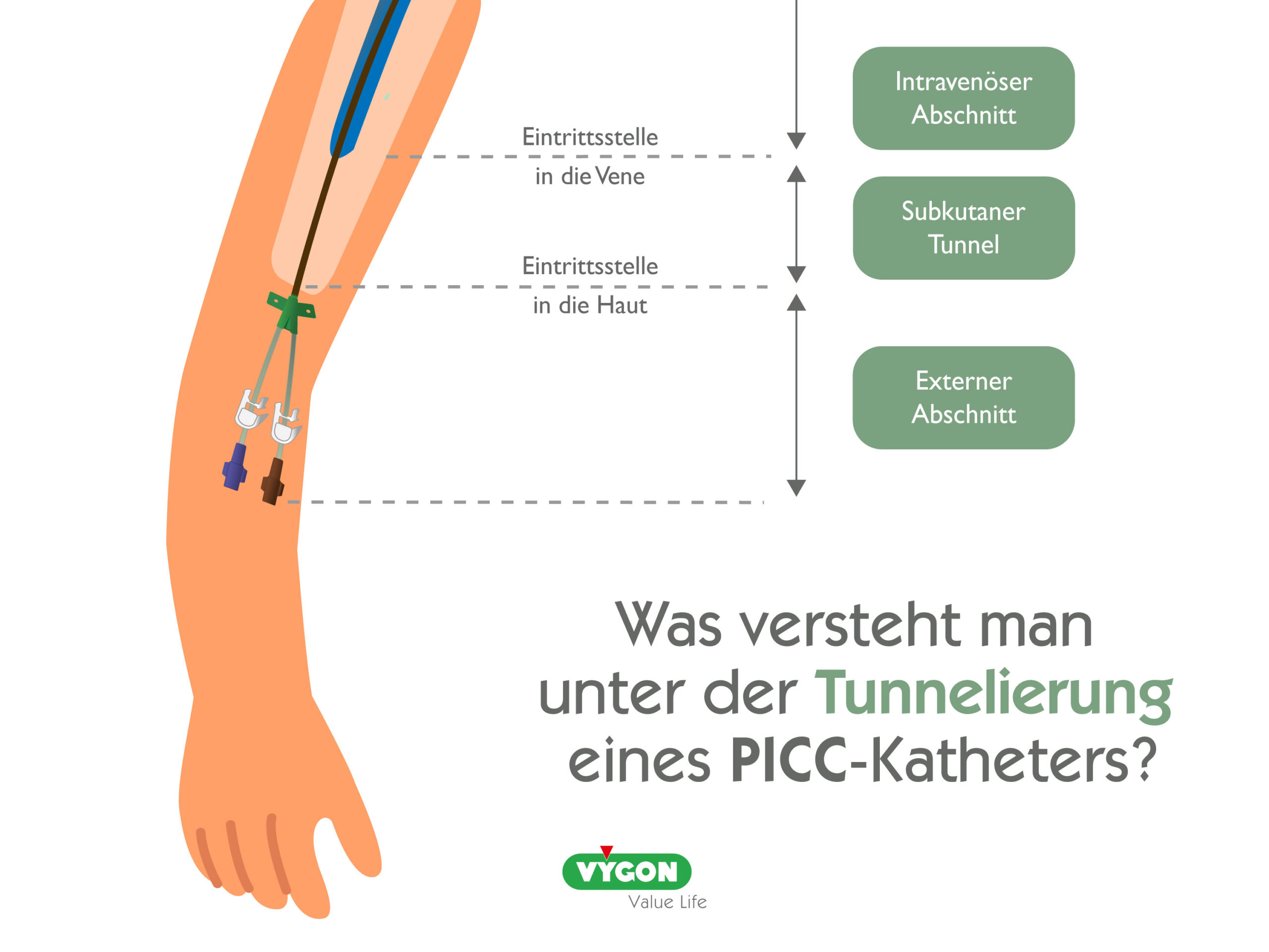 Was versteht man unter der Tunnelierung eines PICC-Katheters