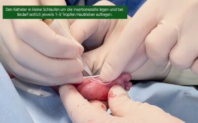 Fixierung eines neonatalen PICC-Katheters mittels Hautkleber