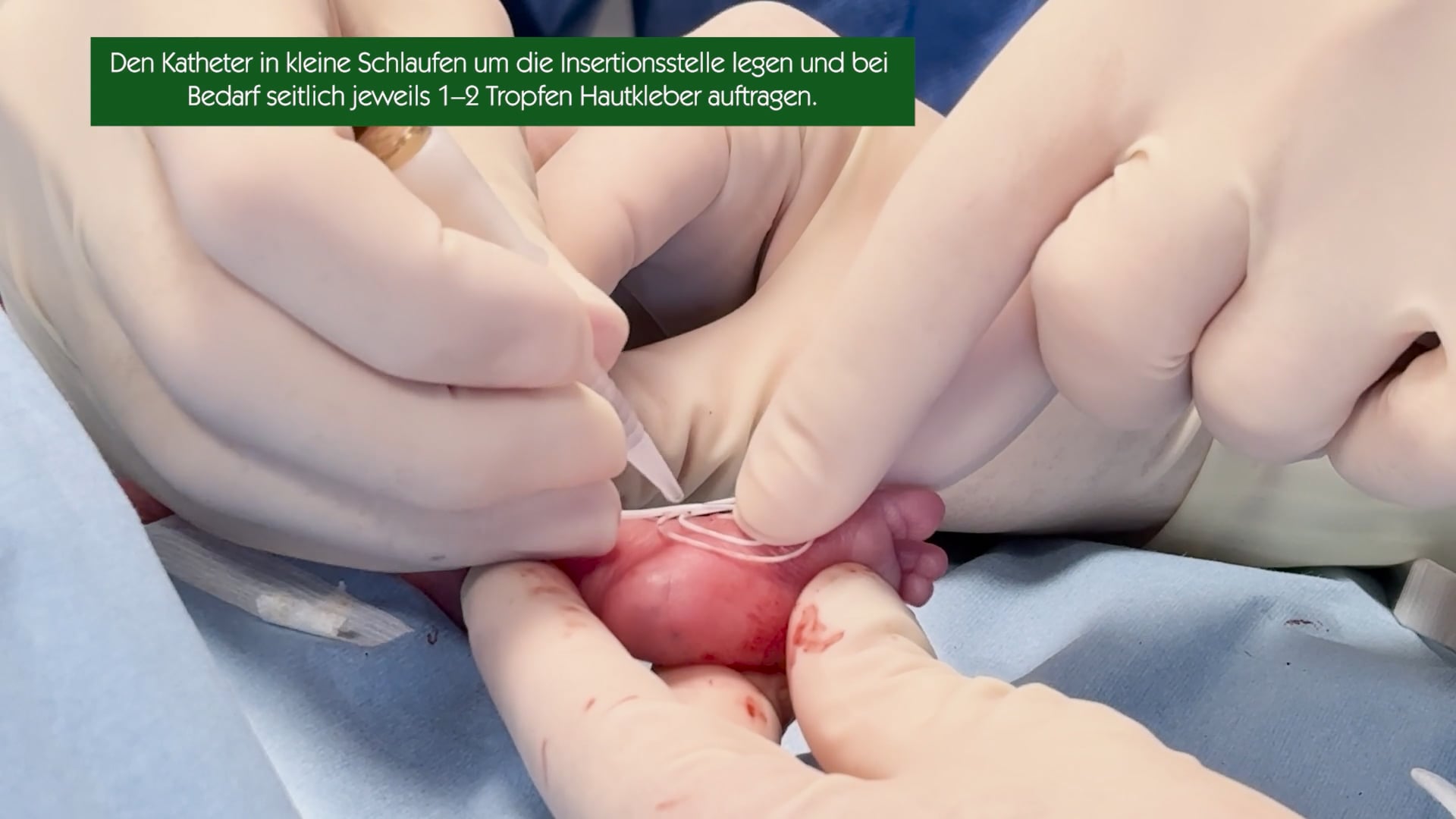 Fixierung eines neonatalen PICC-Katheters mittels Hautkleber