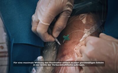 Fixierung eines Mini-Midlines mit dem SecurePortIV Hautkleber