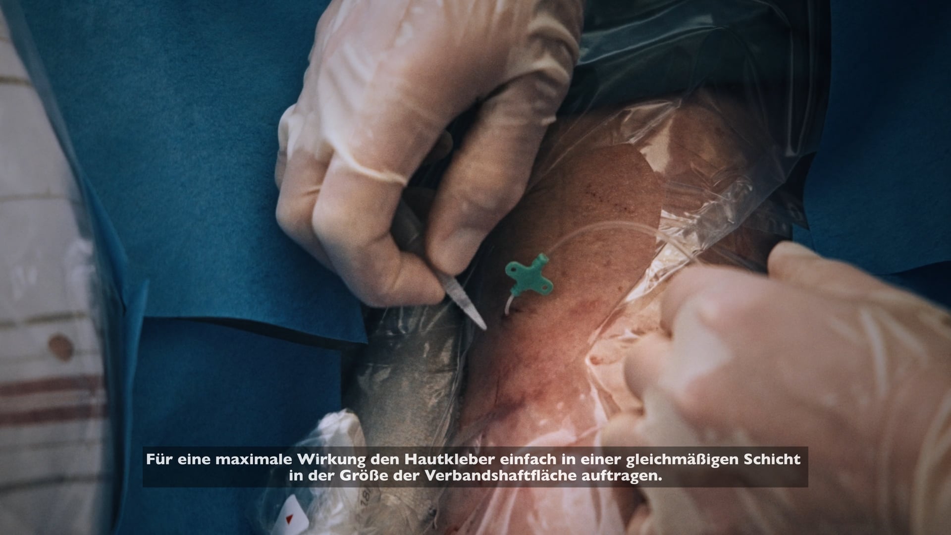 Fixierung eines Mini-Midlines mit dem SecurePortIV Hautkleber