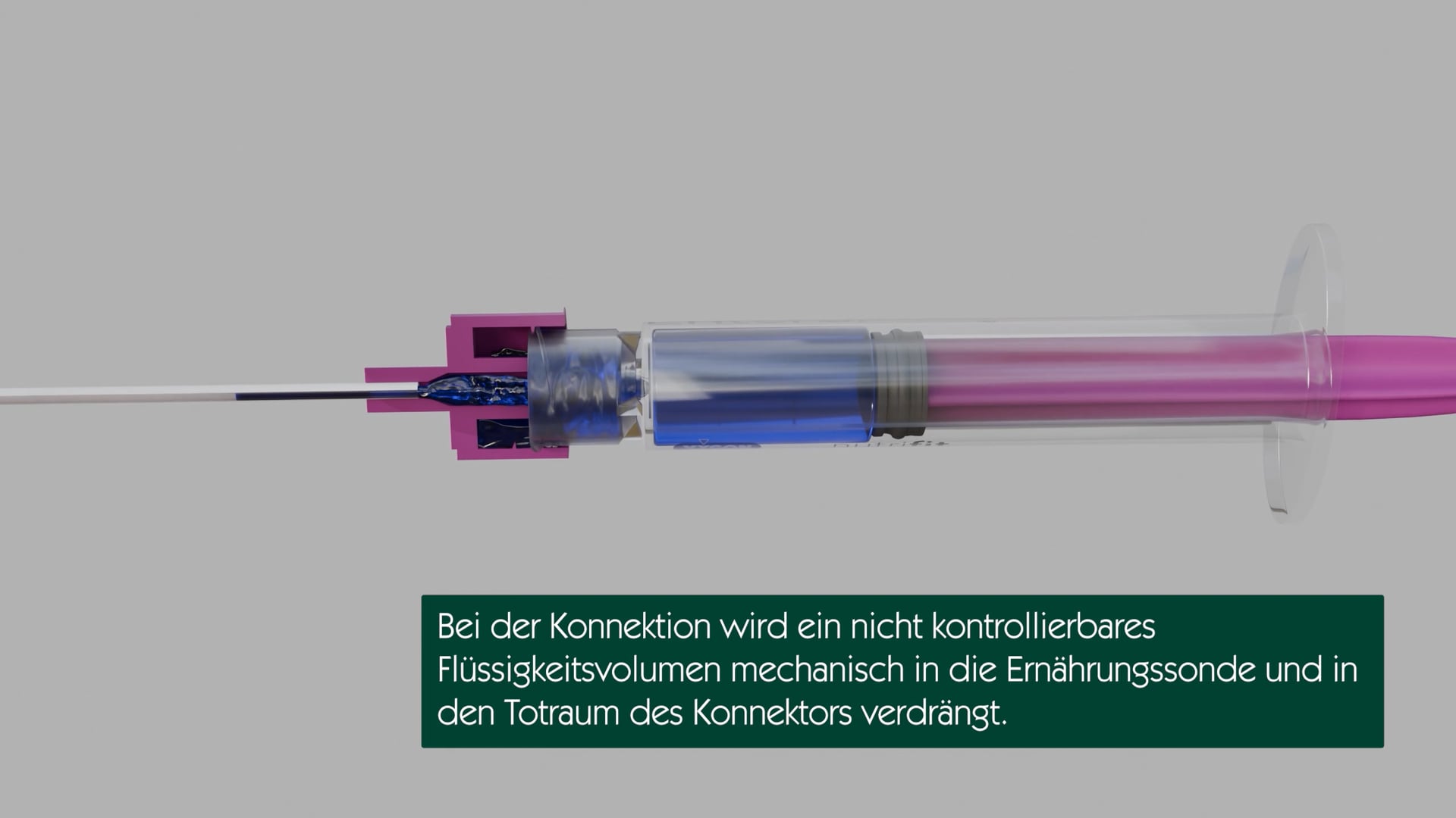 Was geschieht in der ENFit-Ernährungssonde bei der Konnektion?