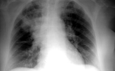 Cómo diagnosticar la infección pulmonar o neumonía asociada a la ventilación (NAV)