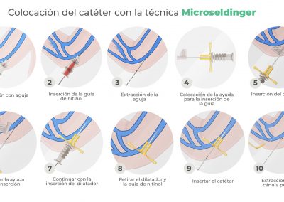 Técnica Microseldinger o Seldinger modificada: colocación de PICC
