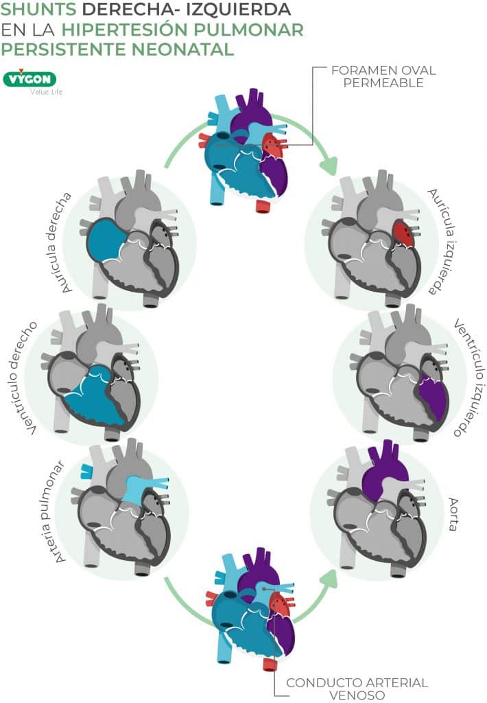 S ndrome De Hipertensi n Pulmonar Persistente Neonatal