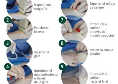 Póster técnica de inserción Microseldinger