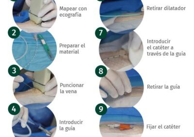 Póster técnica de inserción Seldinger pura