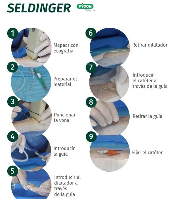 Póster técnica de inserción Seldinger pura