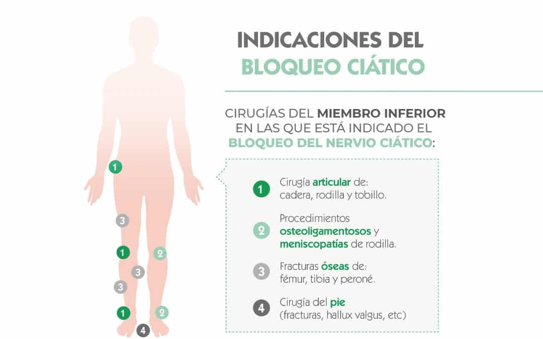 Cirugías del miembro inferior en las que está indicado el bloqueo del nervio ciático.