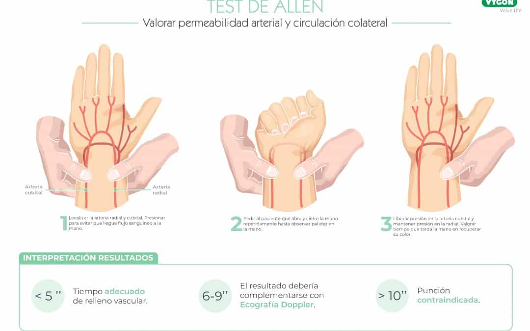 Test de Allen – Canalización arteria radial