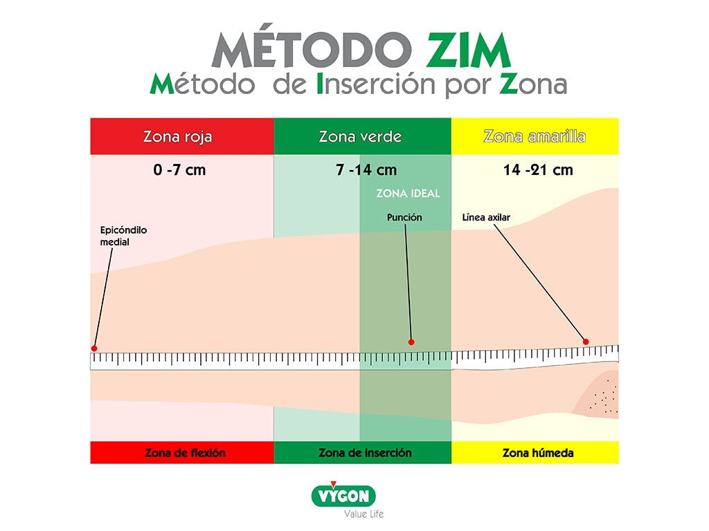 ZIM - Método de Inserción por Zona