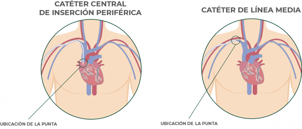 ¿Puede usarse la línea media como un catéter central? - Campus Vygon España