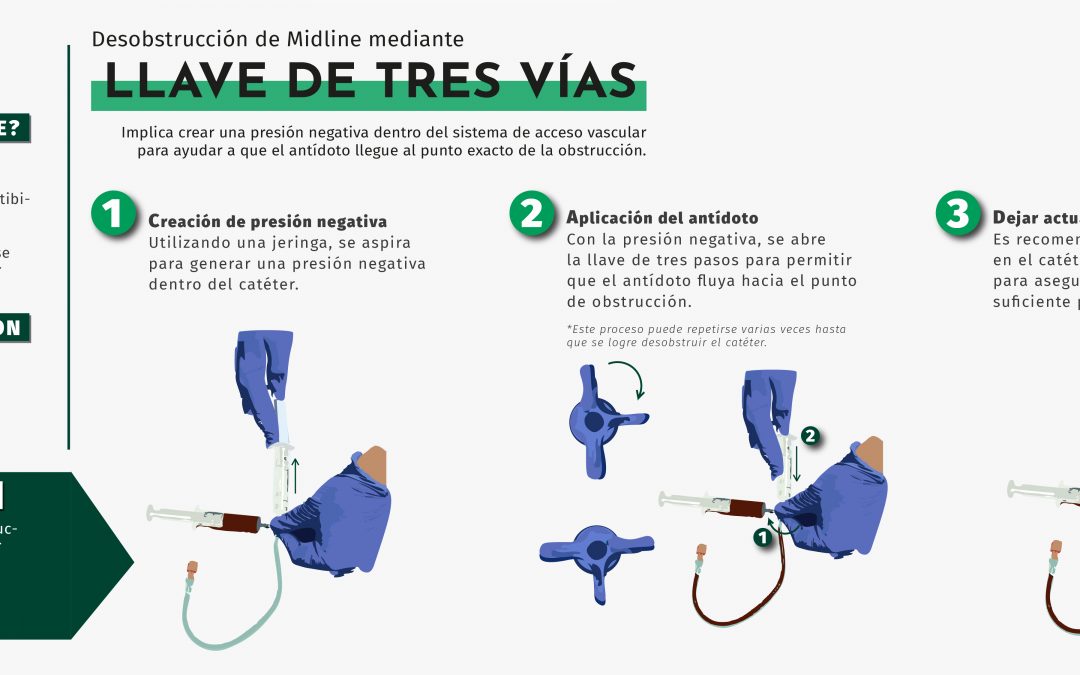 Desobstrucción del Midline mediante Técnica de llave de tres vías