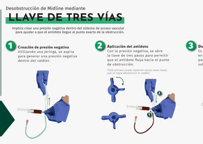 Desobstrucción del Midline mediante Técnica de llave de tres vías