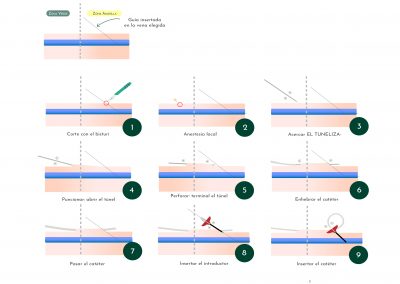 Tunelización anterógrada del Midline