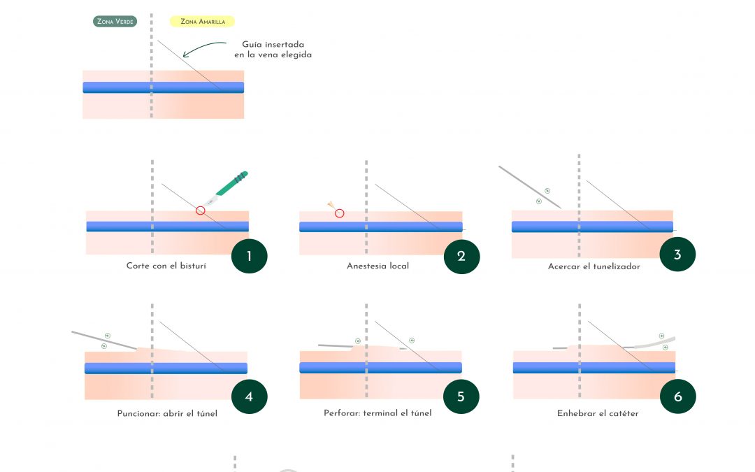 Tunelización retrógrada del PICC con corte proximal