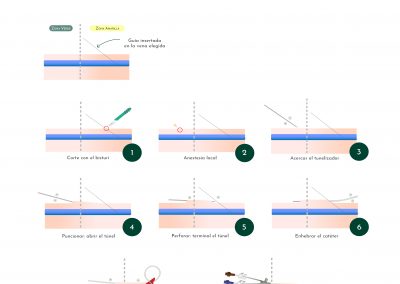 Tunelización retrógrada del PICC con corte proximal