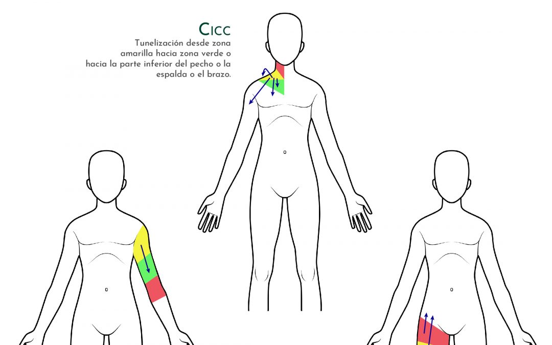 Posibilidades de tunelización en función del tipo de acceso venoso central