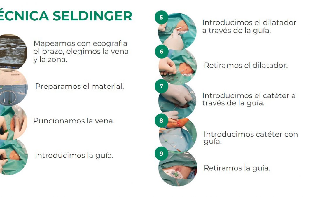 Póster técnica de inserción Seldinger pura