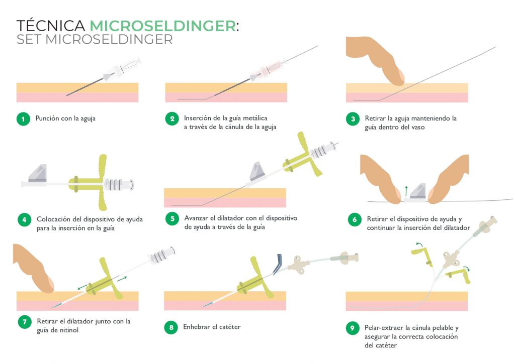 técnica microseldinger