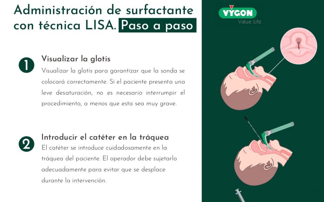 Administración de surfactante con técnica LISA. Paso a paso