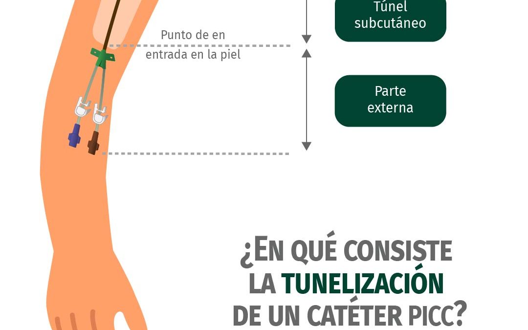 Tunelización de un catéter PICC