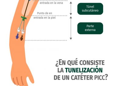 Tunelización de un catéter PICC