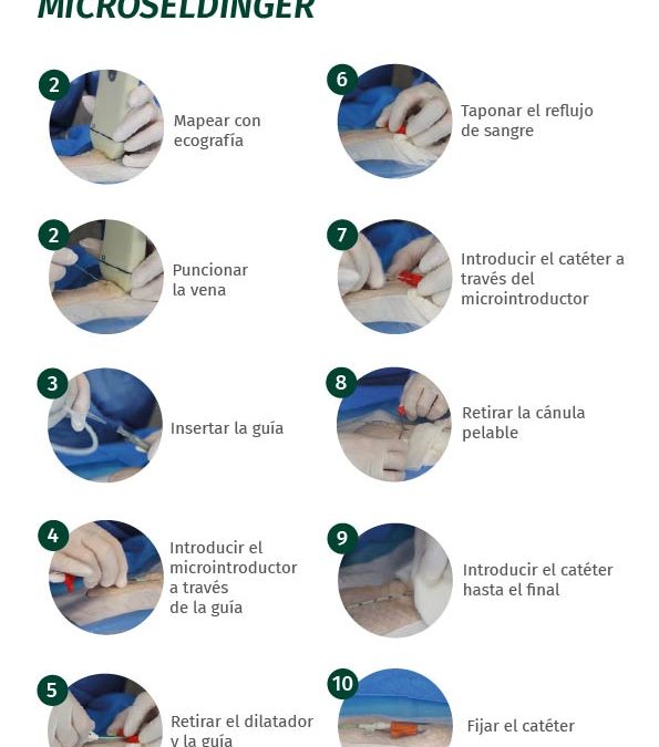 Póster técnica de inserción Microseldinger