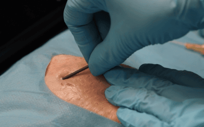 ¿Por qué aplicar la técnica Seldinger con el Midline y la Microseldinger con el PICC?