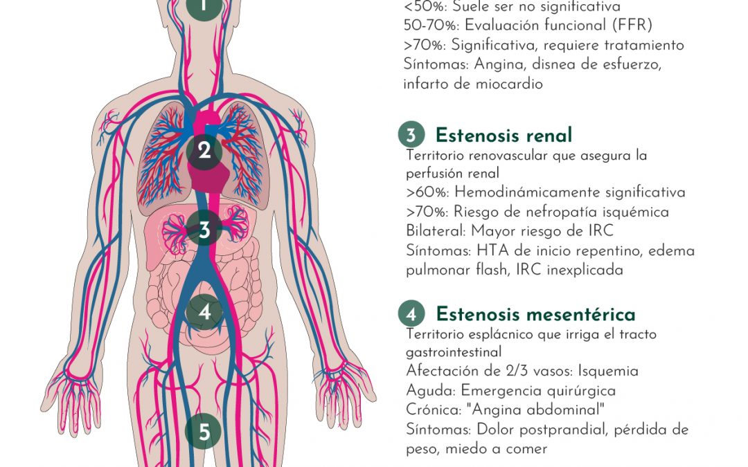 Mapa anatómico de las estenosis vasculares