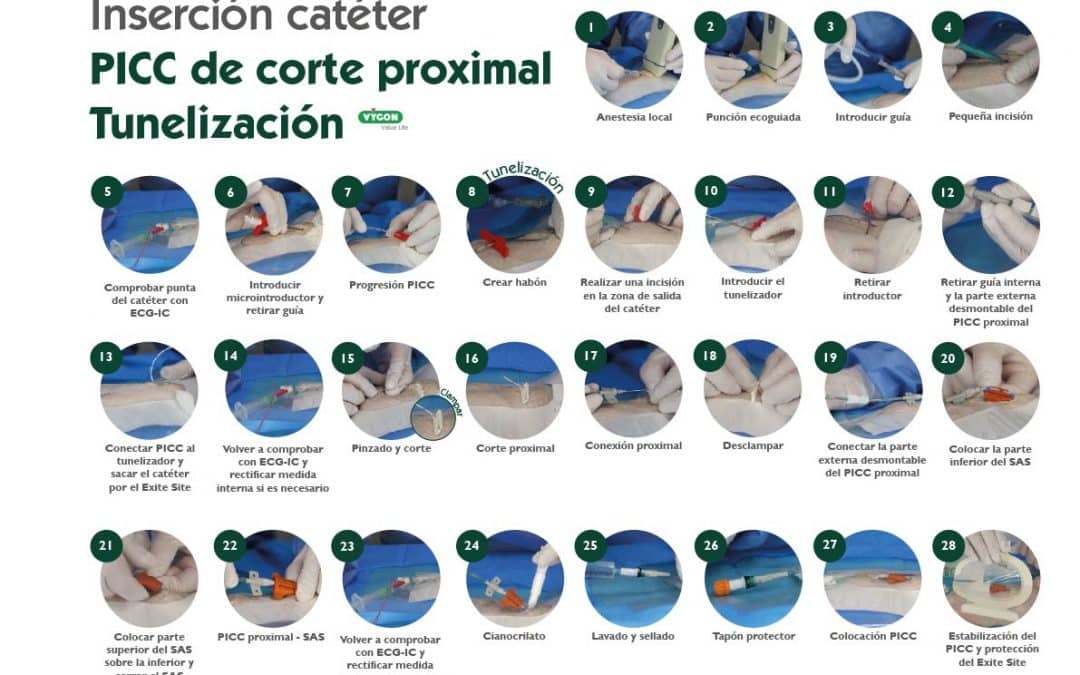 Inserción catéter PICC proximal con tunelización