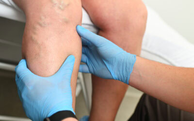 6 claves para prevenir la aparición de flebitis