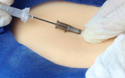 Acceso vascular en oncología pediátrica: ¿Hickman o reservorio?