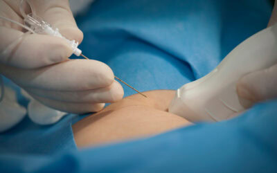 Anestesia espinal o anestesia epidural: ¿cuál es la mejor opción ante una cirugía?