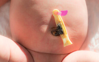 ¿Cómo colocar un catéter umbilical?: Protocolo de inserción y fijación