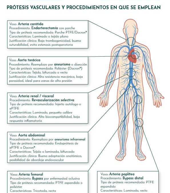 Mapa de aplicaciones clínicas de cada tipo de prótesis vascular