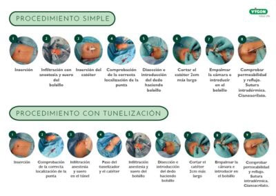 PICC-Port: Inserción con y sin tunelización