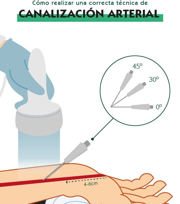 Cómo realizar una correcta canalización arterial