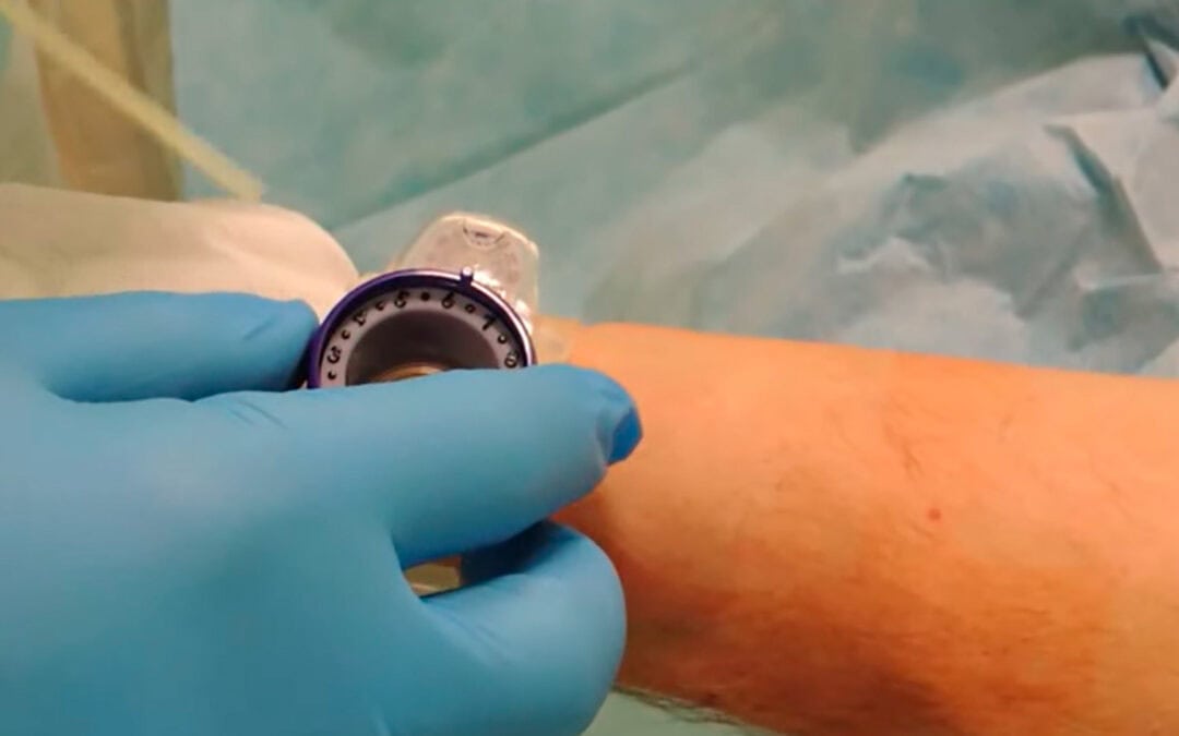 Protocolo de descompresión radial